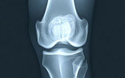 Osteoartrite(Kireçlenmeye) En İyi Gelecek Tedavi Egzersiz Olabilir